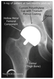 An x-ray of a patient at 2 months post-operation, showing a hip resurfacing.