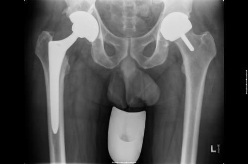 An x-ray showing a hip replacement on one side and a hip resurfacing on the other.